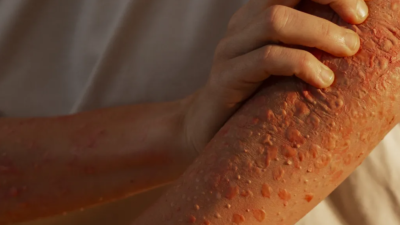 30 Bin Şüpheli Maymun Çiçeği Vakası Görüldü